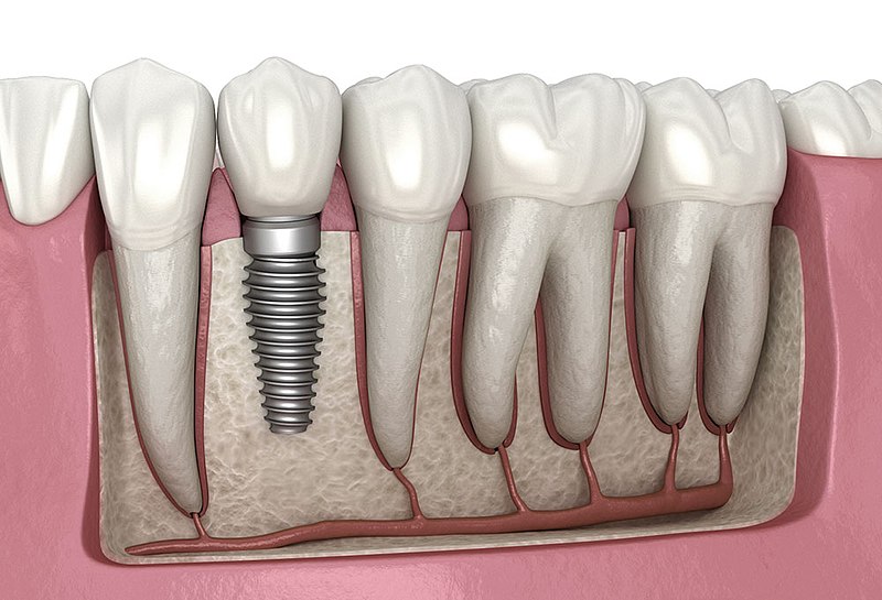 Caring for Dental Implants: A Comprehensive Guide to Maintaining