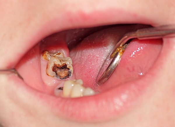 5 Common Causes of Tooth Decay and How to Prevent It