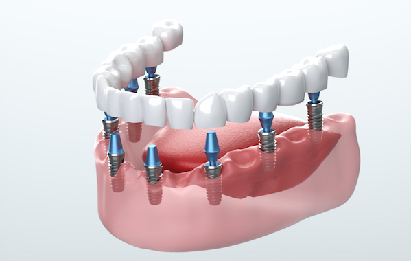 Caring for Dental Implants: A Comprehensive Guide to Maintaining