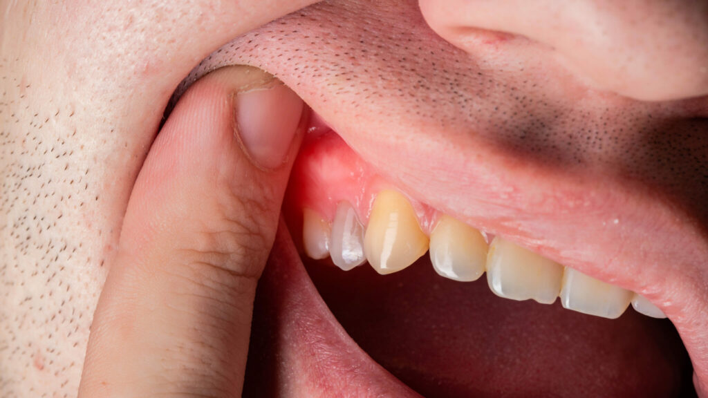AI for Early Detection of Gum Inflammation: A Breakthrough in Dental Care