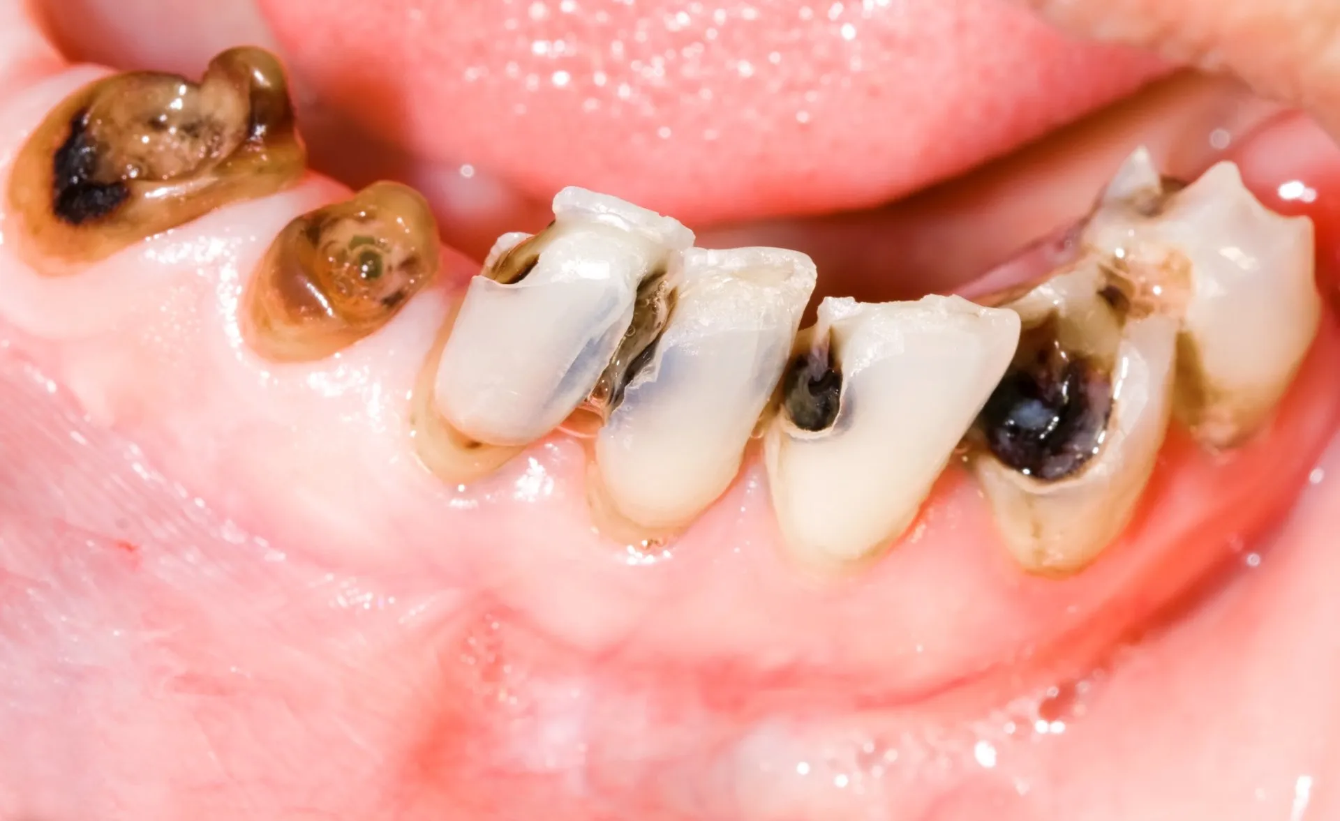 5 Common Causes of Tooth Decay and How to Prevent It